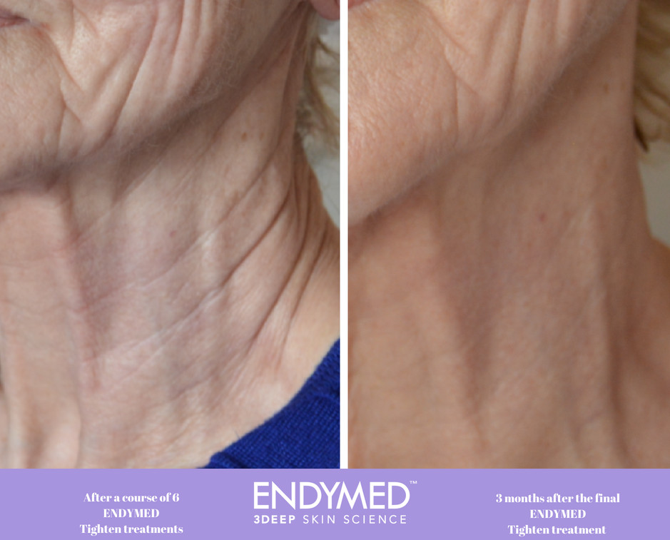 Endymed Pro Before after